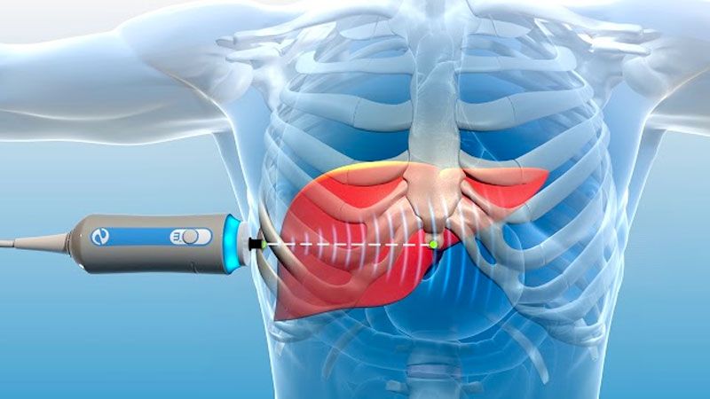 Fibroscan Centre